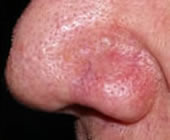 vein removal nose after Rye